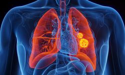 İleri evre akciğer kanserinde "yenilikçi tedavi"