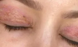 Ucuz estetik sonrası gözüne uyku girmez oldu!