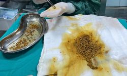 Karın ağrısıyla gitti, safra kesesinden 2 binden fazla taş çıkarıldı