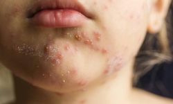 Bangladeş'te kızamık salgını: 6 haftada 113 çocuk öldü