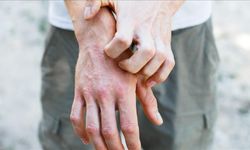 Ciltteki kaşıntı ve kuruluk, hastalıkların ilk sinyali olabilir