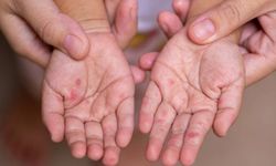 İngiltere'de kızamık alarmı: Bu yıl iki çocuk hayatını kaybetti