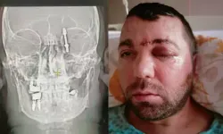 Diş implantı yaptırdı, hayatının şokunu yaşadı