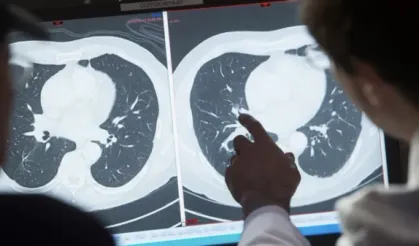 Araştırmaya göre ABD'de 50 yaş altı kişilerde görülen kanser vakaları arttı