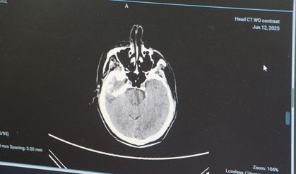 'Gençlerde beyin kanaması görülme oranı giderek artıyor'