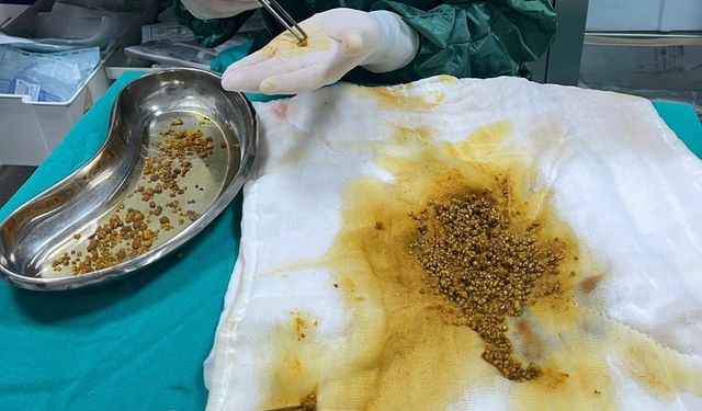Karın ağrısıyla gitti, safra kesesinden 2 binden fazla taş çıkarıldı