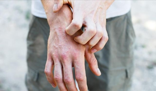Ciltteki kaşıntı ve kuruluk, hastalıkların ilk sinyali olabilir