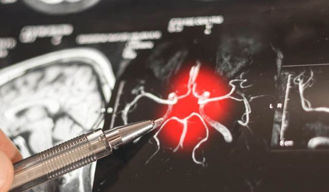 Alzheimer'da gizli evre: Belirtileri erken yaşlarda başlıyor!
