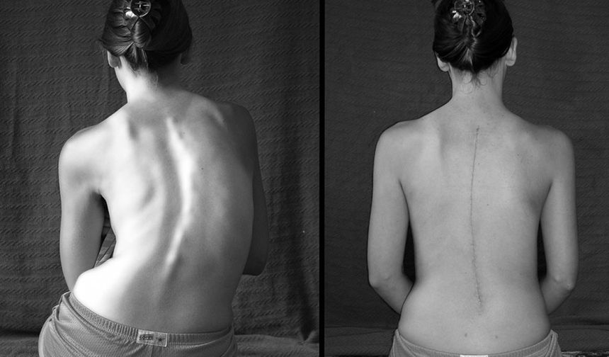 'Skolyozda erken farkındalık tedaviyi kolaylaştırıyor'