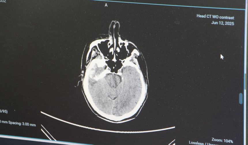 'Gençlerde beyin kanaması görülme oranı giderek artıyor'